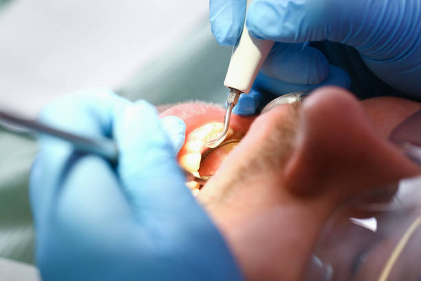 Best Chipped Tooth Repair Near Me  in Kings Park West, VA